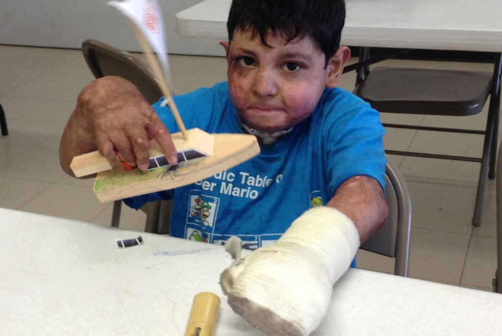 Young boy burn survivor playing with a wooden toy